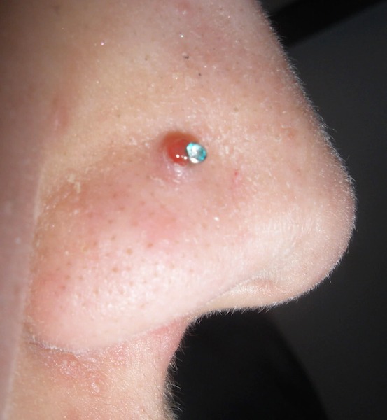 Fastest Way to Get Rid of Nose Piercing Bump