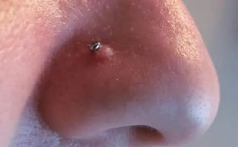 Nose Piercing Bump vs Keloid